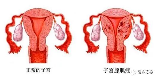 子宫肌瘤一个月能长多大子宫肌瘤一个月能长多大，探究与解析