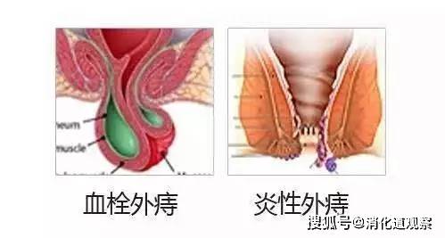 7个月宝宝肛门有痔疮关于7个月宝宝肛门痔疮的文章